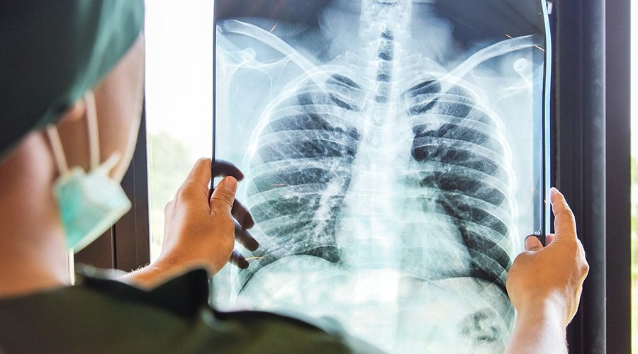 Gizli akciğer kanseri, tomografilerde ortaya çıkıyor